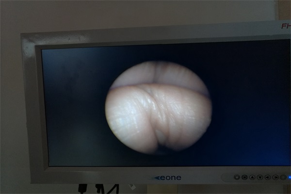 腹腔镜监视器